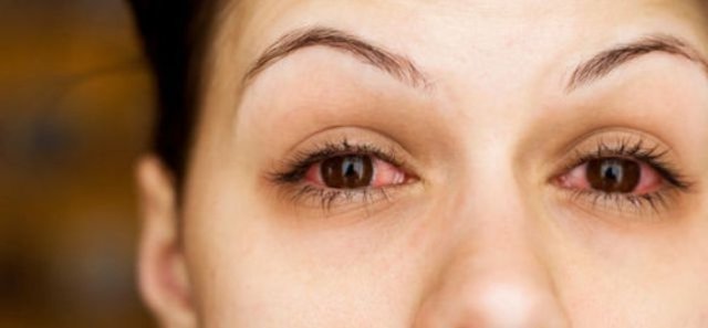 Öte yandan gözü alerjik yapıdaki kişilerin, gözünü sürekli kaşıması, ovuşturması mevcut olan hastalığın gelişimini hızlandırır. Tabi ki göz alerjisi olan herkesin bu hastalığa yakalanacağı anlamını da çıkarmamalıyız" diye konuştu.