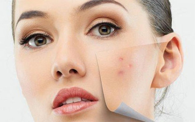 Gazete Habertürk - Sivilceler yıllardır başa bela oldu. Doğru beslenme ve su tüketimiyle sivilceleri yok etsekte bu sefer de izleri peşimizi bırakmıyor.