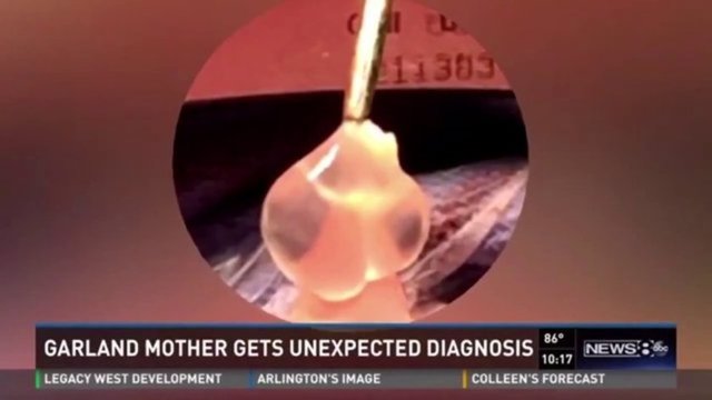 Mirror'ın haberine göre; Doktorlar, şiddetli baş ağrıları yaşayan kadının beyninde büyüyen bir tenya larvası buldular.