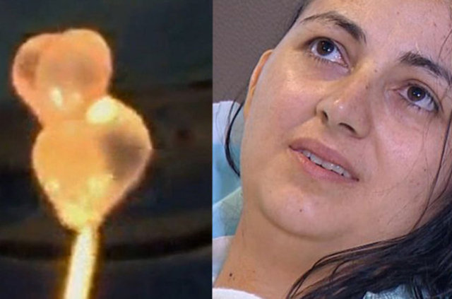 Beyninde kurt larvası olduğu belirlenen kadın ameliyata alındı. 31 yaşındaki kadın şimdi 2 yıl önce yaptığı Meksika gezisinde hastalık kaptığına inanıyor.