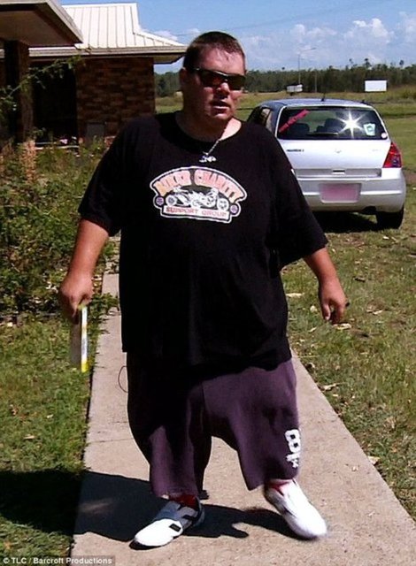 HABERTURK.COM / SAĞLIK SERVİSİ  Testis torbası karpuz büyüklüğünde olan 25 yaşındaki Tyrone Bowd, şişen testis torbasının cerrahiyle alınması konusunda artık oldukça umutsuz…