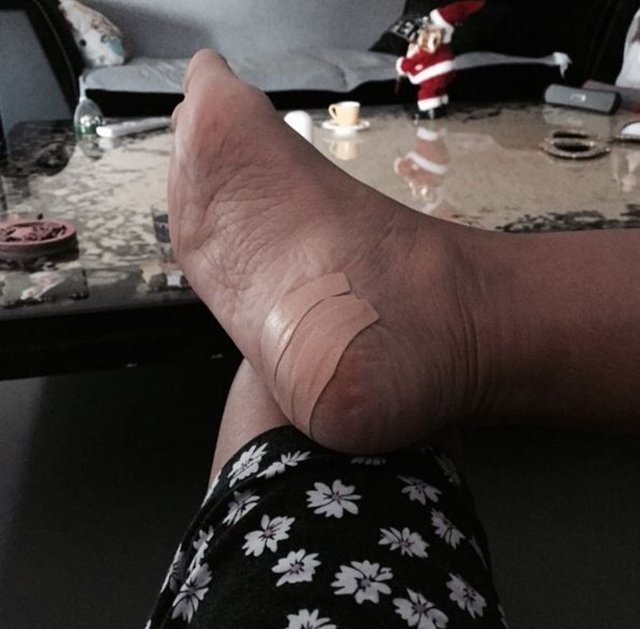 DEMET AKALINÜnlü şarkıcı Instagram hesabından şişen ayağının fotoğrafını "Evde ayağıma cam girdi, pes" notuyla paylaşmıştı. Sosyal medyada olay olan fotoğrafın altına "Babaannenin ayağı mı!", "Bu ayak senin olamaz, eşin Okan Kurt'un ayağını mı paylaştın?" gibi yorumları yazılmıştı.