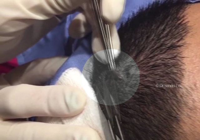 Dermatolog Dr. Sandra Lee neşteri ve sivilce sıkmasıyla biliniyor. Ayrıca Dr. Lee, bu tip hastalar video çekimine izin verdiklerinde tedavilerini bedavaya yaptırabiliyor.