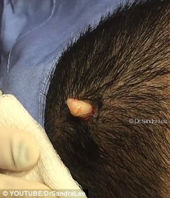 Dr. Lee, küçük bir kesinin ardından hastaya iki dikiş gerektiğini söyledi.