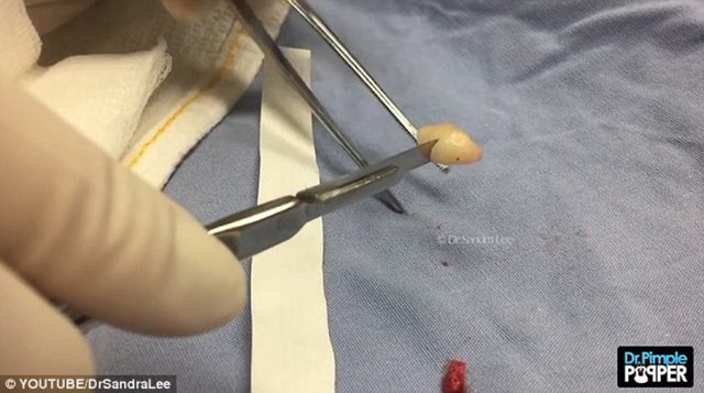 Onlar genellikle erkeklerden daha çok orta yaşlı erişkinlerde ve kadınlarda görülür.