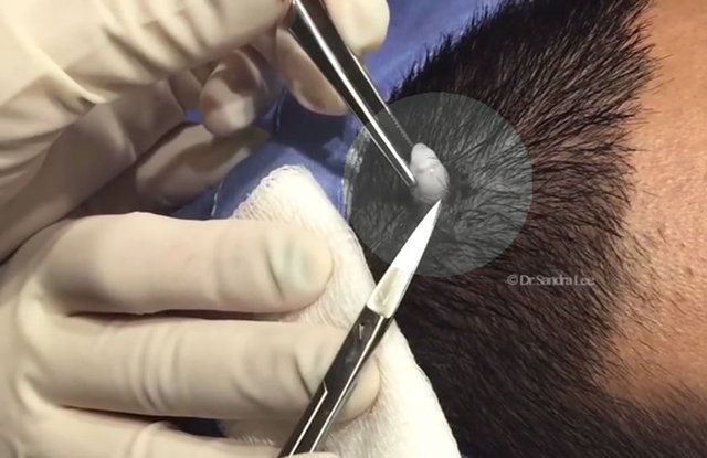 Dr. Lee, çıkan bu bezenin sıklıkla baş üzerinde çıkabilen dermatolojik bir sorun olan pilar kist olduğunu açıkladı.