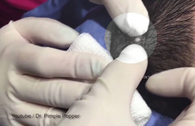 Kafasındaki şişliğin giderek büyüdüğünü söyleyen hastaya California'da ünlü sivilce sıkıcısı olarak bilinen  Dermatolog Dr. Sandra Lee, şunları söyledi: 'Neşterle kesince şişlik dışarı çıktı. Adeta bir boynuz gibi görünen şey yukarı doğru çıkmaya başladı.'