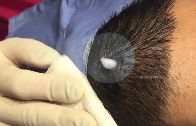 Kafasından çıkanın iltihap olup olmadığını soran hastaya yapılan açıklamaya göre kafasındaki şeyin ıslak, ölü deri olduğu söylendi.