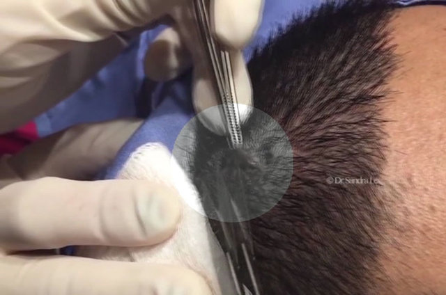 Kafasındaki şişlik onu rahatsız etmeye başlayınca ünlü dermatologa gitmeye karar verdi. 