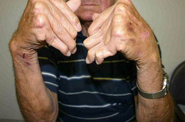 Yeterli su; artriti önler. Su eklemlerin yağlanmasını sağlar ve artritin oluşmasını engeller.