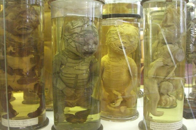 Paris'teki bu müzede doğumsal anormallikler, ölü bebekler, intihar edenlerin iskeletleri, kafatası kırılanlar gibi tüyler ürpertici sergi yapılıyor.