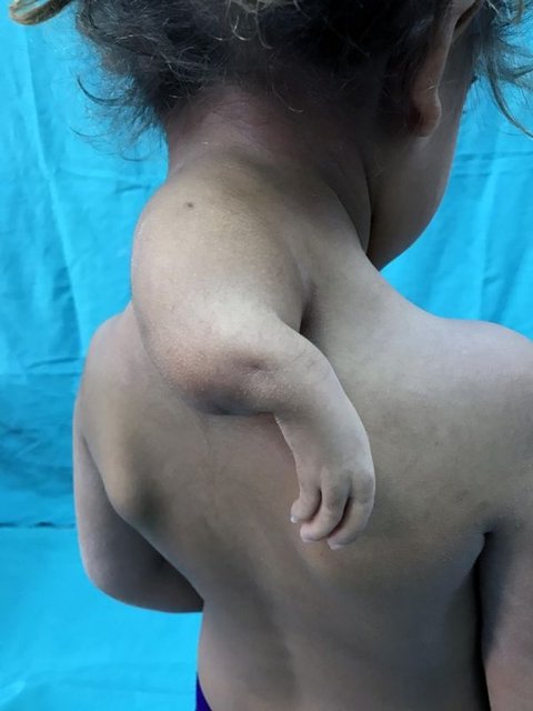 Aile, Şanlıurfa'daki doktorların yönlendirmesiyle minik çocuğu, Adana'daki Çukurova Üniversitesi Tıp Fakültesi Balcalı Hastanesi Ortopedi ve Travmatoloji Uzmanı Prof. Dr. Cenk Özkan'a getirdi.