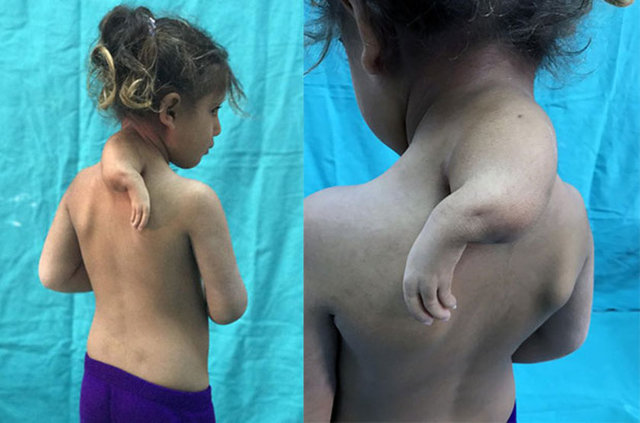 Şanlıurfa'nın Akçale Kale İlçesi'nde 4'ü ikiz olmak üzere 5 çocuklu inşaat işçisi İbrahim ve ev kadın Meryem Enzelik çiftinin 4 yıl önce Hülya adını verdikleri bir kızları oldu. Omzunda 3'üncü bir kol bulunan bebek, herkesi şaşkına çevirdi.