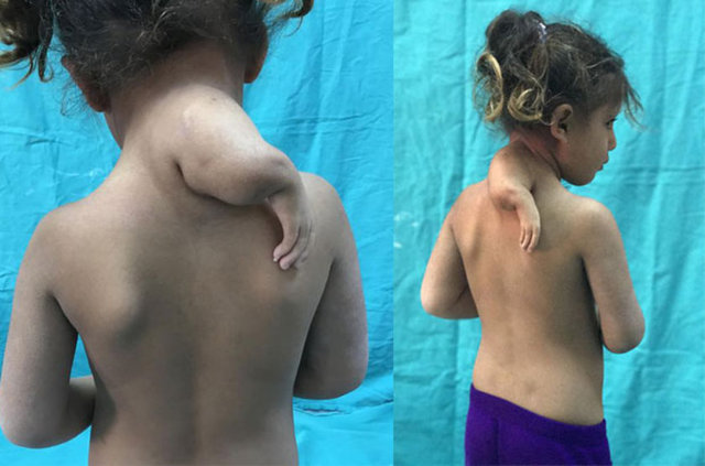Biz bu fazla kolun çocuğa yük olmak dışında bir faydası olmadığından oradan uzaklaştırdık. Normal kendi kolundan biraz daha küçük ama bariz bir şekilde içerisinde fonksiyonu bulunmayan parmakları ve eli de olan o kolu cerrahi bir operasyonla çıkarttık.