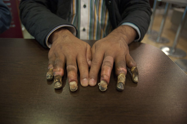 TÜRKİYE'YE GİRMEDEN HEMEN ÖNCE, KAÇAKÇILARIN ROTASINI GÖRMEMESİ VE HATIRLAMAMASI İÇİN SADECE ÖNÜNE BAKMASINA İZİN VERİLEN, BUNU GARANTİ ALTINA ALMAK İÇİNSE PARMAKLARINDAN TELLERLE BAĞLANIP YOL BOYUNCA DÖVÜLEN ÜZEYİR'İN PARMAKLARI, DONDURUCU SOĞUKLA BİRLEŞİNCE NEKROZA TESLİM OLDU.