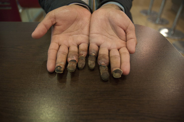 PAKİSTAN'DA KENDİNE BİR GELECEK GÖREMEDİĞİ İÇİN VATANINI TERK EDİP ACIMASIZ İNSAN KAÇAKÇILARININ TUZAĞINA DÜŞEN ÜZEYİR, TÜRKİYE'DEN BİRKAÇ HAFTA ÖNCE DEPORT EDİLDİĞİ ÜLKESİNDE ARTIK BAZI İŞLEVLERİNİ KAYBETMİŞ OLAN BU PARMAKLARLA YAŞAMA TUTUNMAK ZORUNDA.