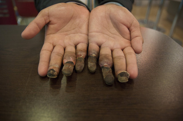 DAHA SONRA TÜRKİYE'DE BİNBİR TEREDDÜTLE GİTTİĞİ DOKTORUNUN VERDİĞİ BİLGİYE GÖRE ÜZEYİR, HER İKİ ELİNDE DE ÜÇ, DÖRT VE BEŞİNCİ PARMAKLARININ UÇ KISIMLARINI KAYBEDECEK.