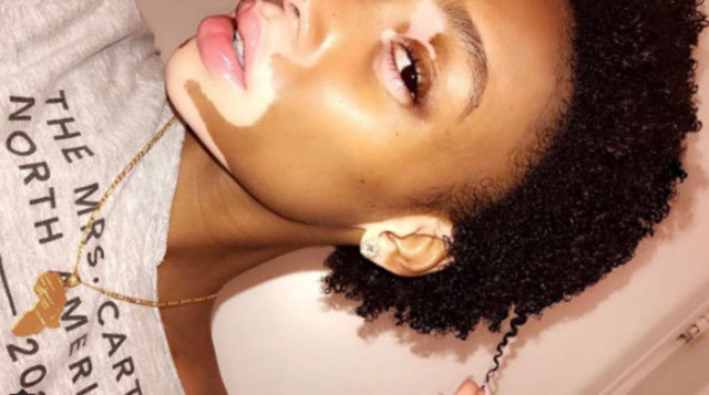 Şimdilerde en büyük markalarla çalışan Harlow, şöhretini vitiligo hastalığı sözcüsü olarak kullanmayı da ihmal etmiyor ve kendisi gibi olanlara yardım ediyor.