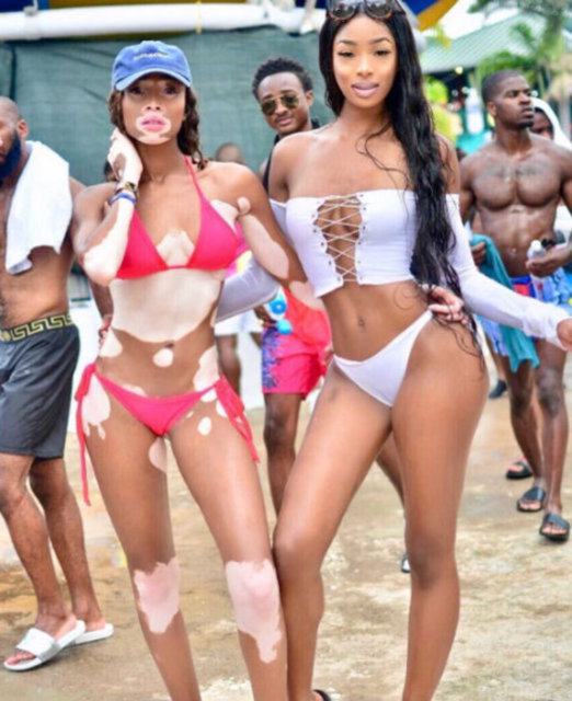 Dört yaşından beri cildin pigment kaybetmesine sebep olan, vitiligo ile yaşayan Harlow pek çok zorlukla mücadele etmek zorunda kaldı. -  