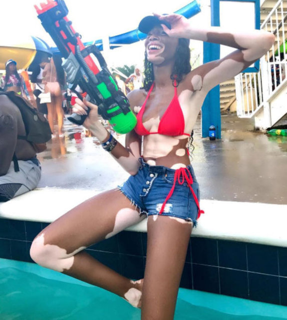 SÜPER MODEL TYRA BANKS KEŞFETTİ - Instagram'da süper model Tyra Banks tarafından keşfedilen Kanadalı model Winnie Harlow, deri hastalığı vitiligoya sahip olmasıyla tanınıyor. -  