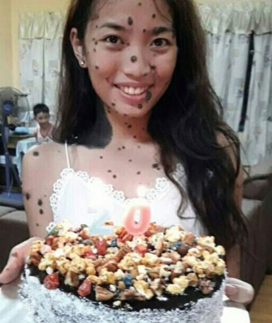 Evita Patcey Delmundo, her ne kadar büyüme çağındayken benleri yüzünden alay konusu olsa da şimdi sosyal medyada oldukça tanınıyor ve "Bir insanı güzel yapan kendisine özel bazı farklılıkları olması güzel" diye belirtiyor.