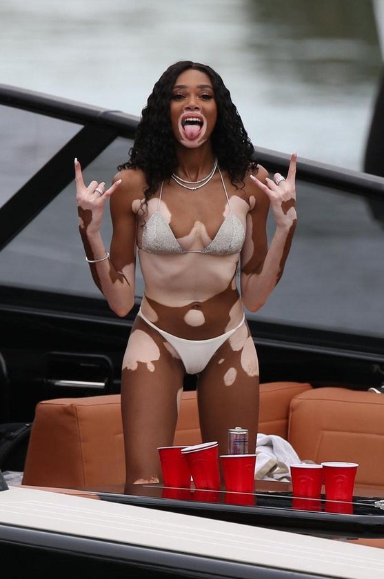 Winnie Harlow Nude Pics