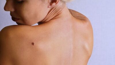 Gözümüzün önündeki kansere dikkat: Melanom