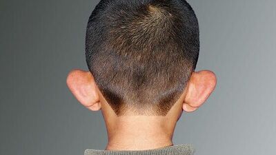 Kepçe kulak estetiği en sık kullanılan estetik türüdür...