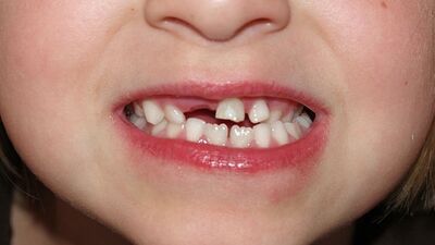 Kırılan dişi kurtarabilirsiniz!