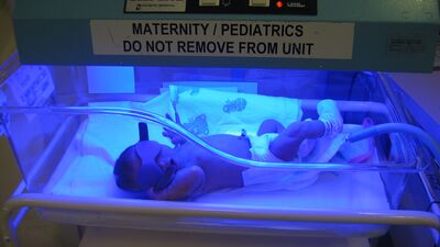 Doğar doğmaz sarılık oldu