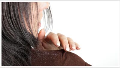 Kepekli saçlara kesin çözüm