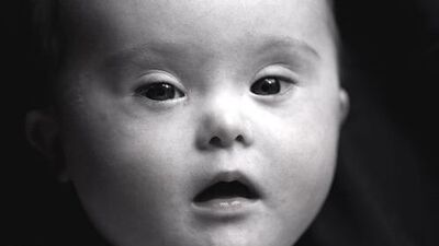 Neler down sendromuna neden olur?