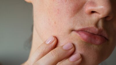 Stres sadece hayatımızı değil cildimizi de etkiliyor