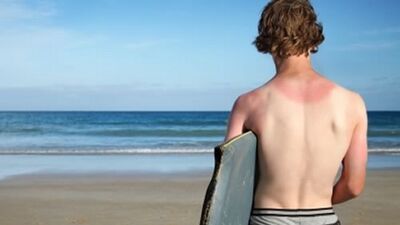 En tuhaf güneş yanıkları