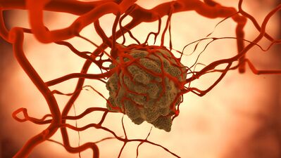 Kanser tedavisinde sıcak kemoterapi yaşam süresini uzatıyor!