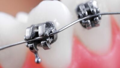 Çocuklarda diş teli kullanımının önemi...