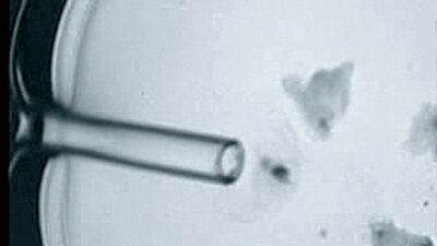 Tüp bebek sürecinde yumurtaların toplanması