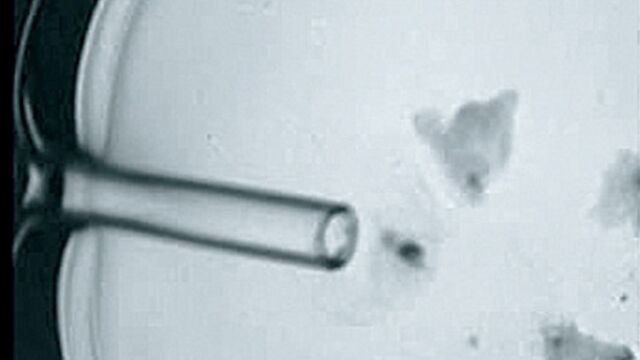 Tüp bebek sürecinde yumurtaların toplanması