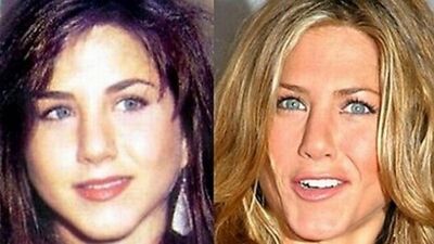 Ünlülerin estetik öncesi ve sonrası halleri...