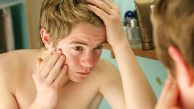 Sınav stresi sivilce yapmasın!