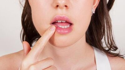 Uçukları elma sirkesiyle yok edin