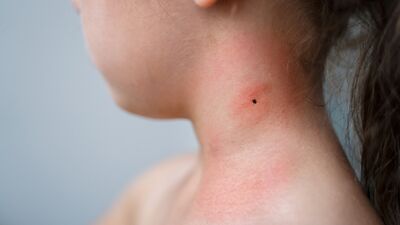 Lyme hastalığı hakkında bilmeniz gerekenler