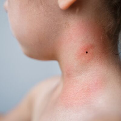 Lyme hastalığı hakkında bilmeniz gerekenler