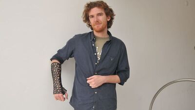 'Bu alçıyla kemik daha çabuk iyileşiyor'