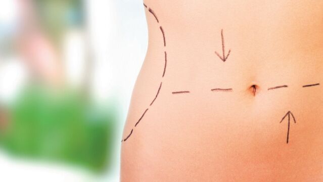 Doğum sonrası estetik