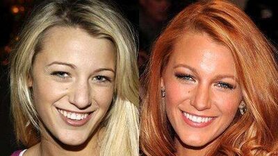 Burun estetikli ünlüler