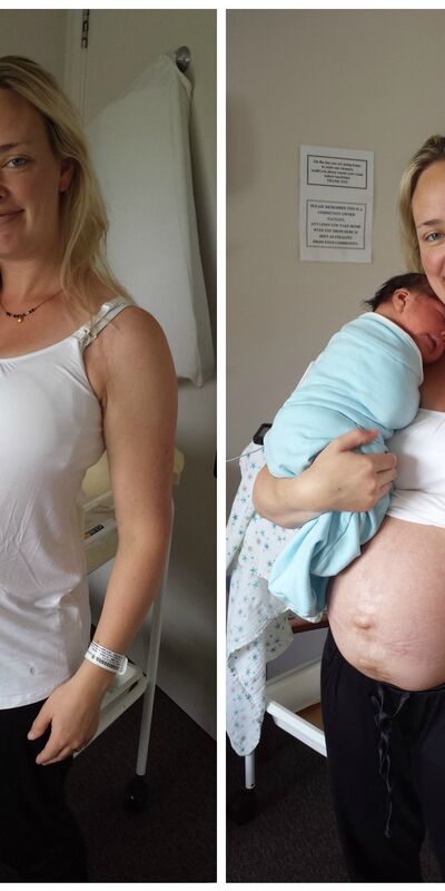 Doğum sonrası göbeğinizden korkmayın!