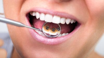 Görünmez diş teline ne dersiniz?