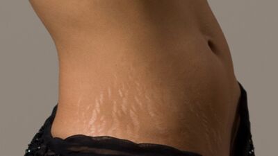 Çatlaklardan nasıl kurtulurum?