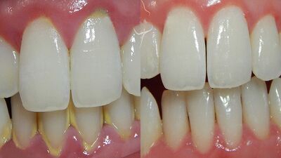 Diş tartarına doğal çözüm